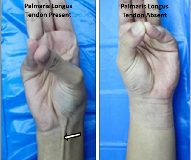 Palmaris Longus Tendon